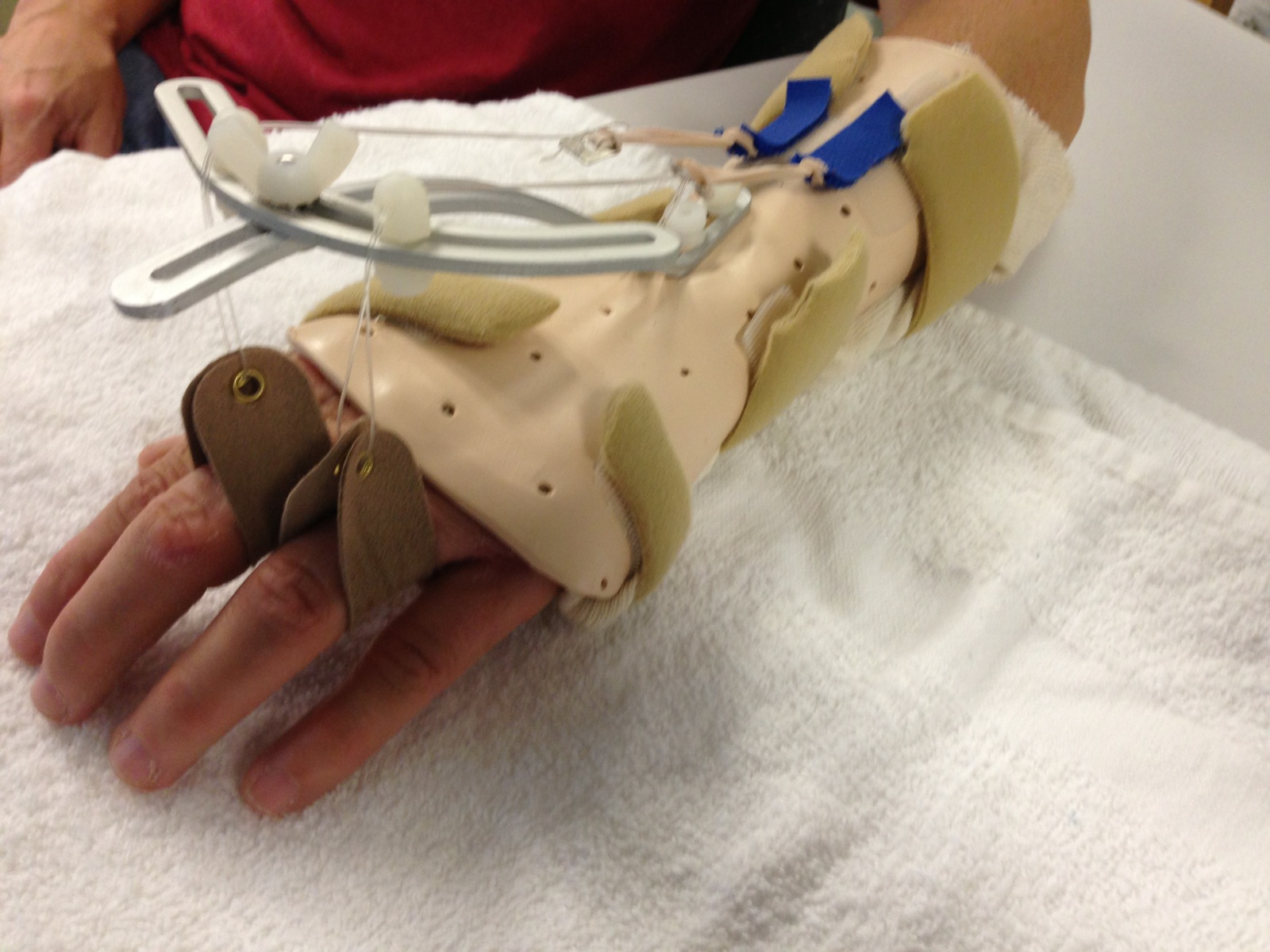 Custom splinting is used post operatively for protection/immobilization